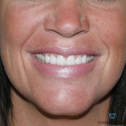 Veneers Case 1 - After