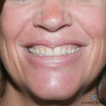 Veneers Case 1 - Before