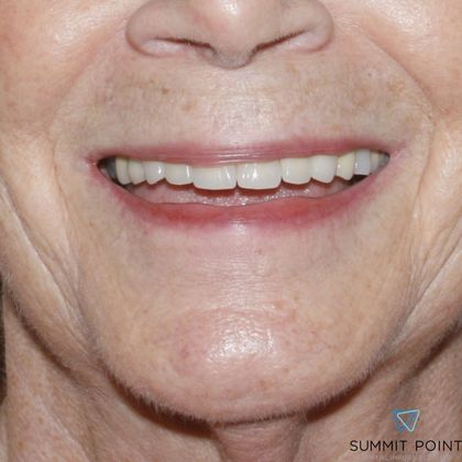 Dental Crowns Case 1 - After