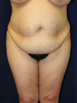 Tummy Tuck*: Case 1 - Before