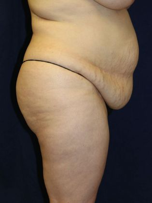 Tummy Tuck*: Case 1 - Before