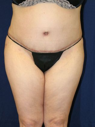 Tummy Tuck*: Case 1 - After