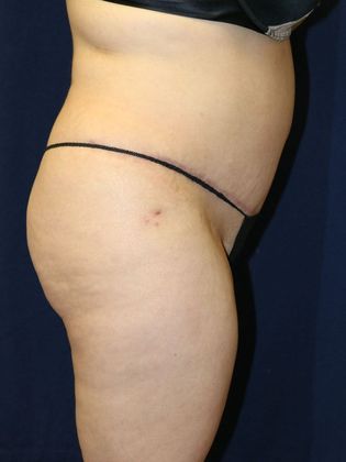 Tummy Tuck*: Case 1 - After