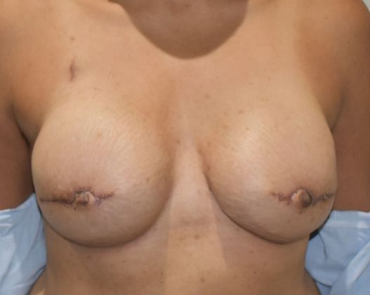 Breast Reconstruction Case 71 - After