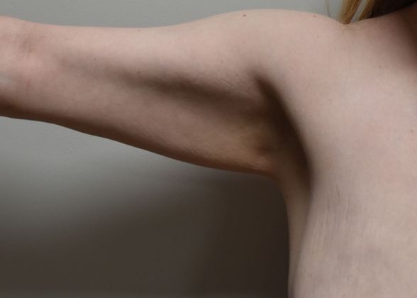 Brachioplasty Case 14 - Before