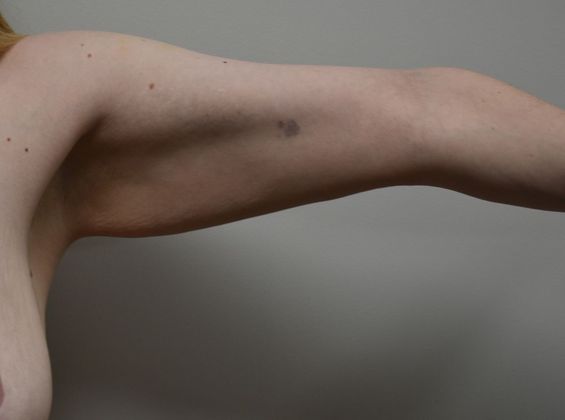 Brachioplasty: Case 14 - Before