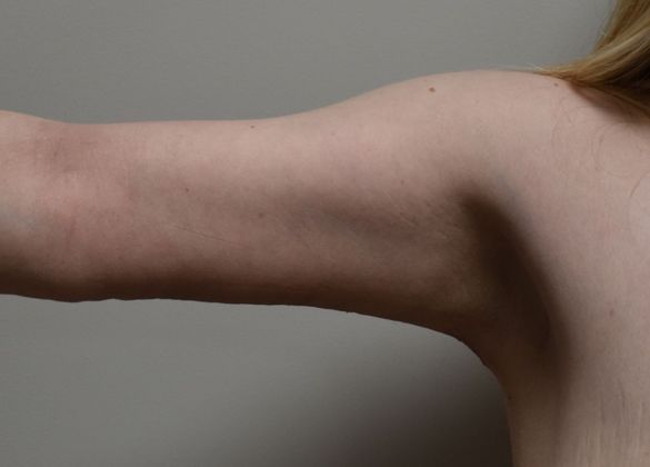 Brachioplasty Case 14 - After