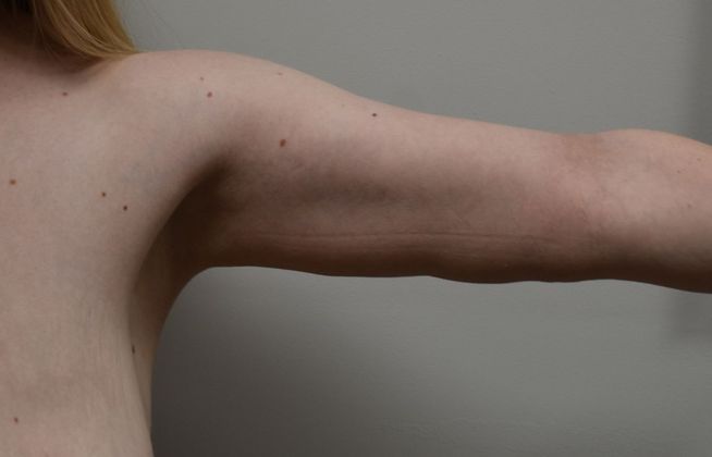 Brachioplasty: Case 14 - After
