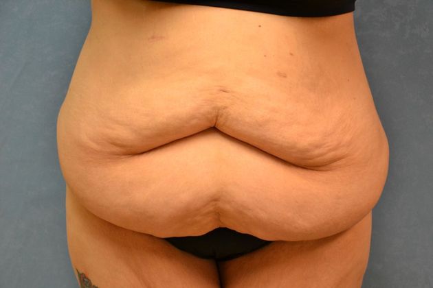 Bodylift Case 1526- Sylvania, OH - Before