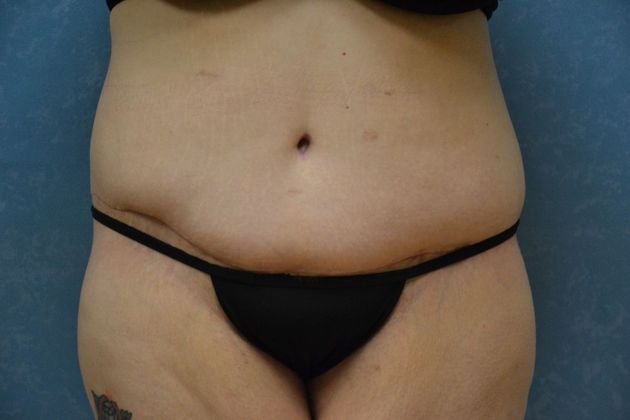 Bodylift Case 1526- Sylvania, OH - After