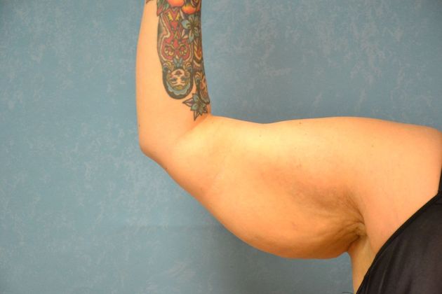 Arm Lift Case 1409- Sylvania, OH - Before