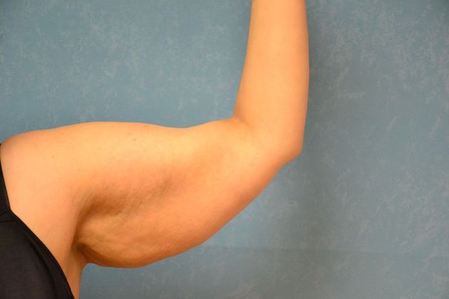 Arm Lift: Case 1409- Sylvania, OH - Before