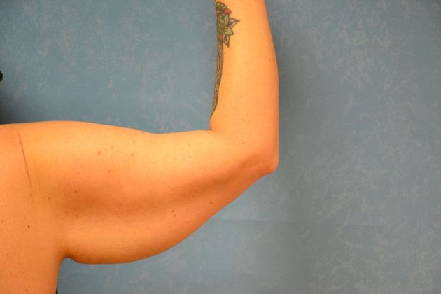 Arm Lift: Case 1409- Sylvania, OH - Before