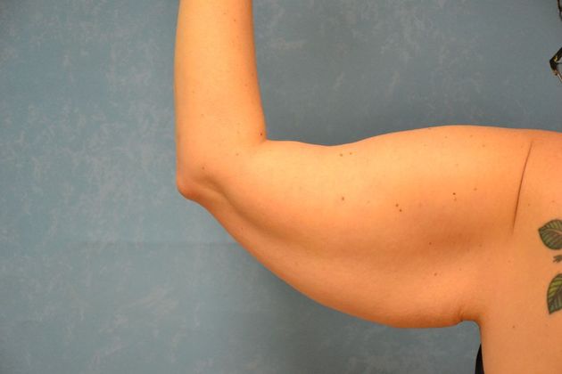 Arm Lift: Case 1409- Sylvania, OH - Before