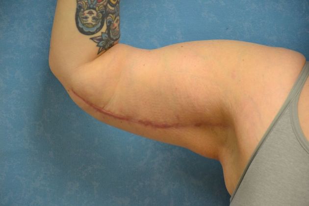 Arm Lift Case 1409- Sylvania, OH - After