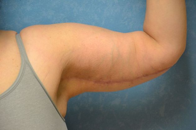 Arm Lift: Case 1409- Sylvania, OH - After