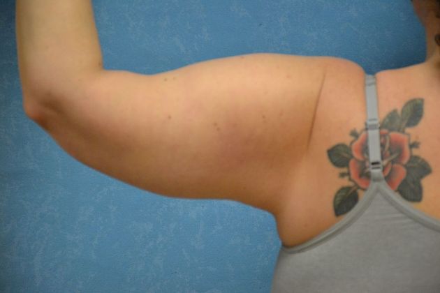 Arm Lift: Case 1409- Sylvania, OH - After