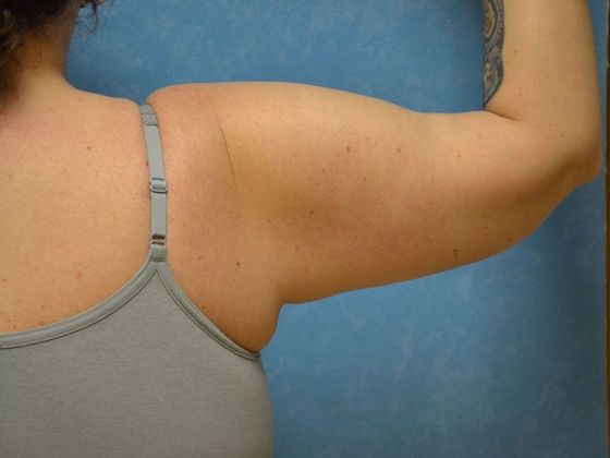 Arm Lift: Case 1409- Sylvania, OH - After