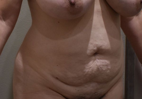 Tummy Tuck (Abdominoplasty): Case 271 - Before