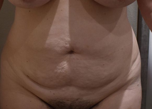 Tummy Tuck (Abdominoplasty): Case 271 - Before