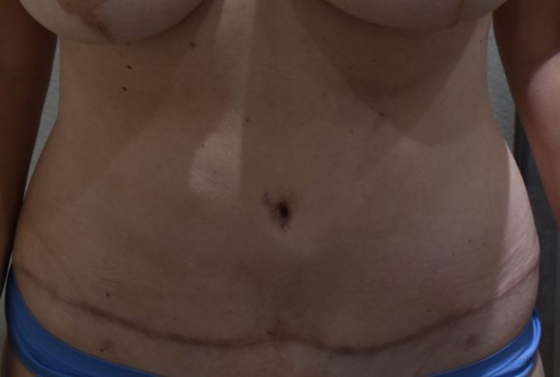 Tummy Tuck (Abdominoplasty): Case 271 - After