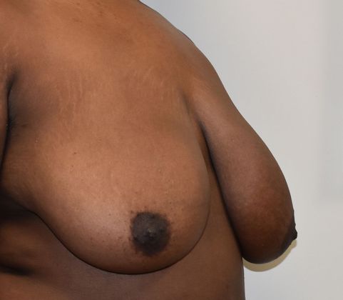 Breast Reduction: Case 112 - Before