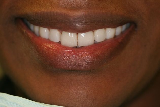 Orthodontics & Veneers Case 5 - After