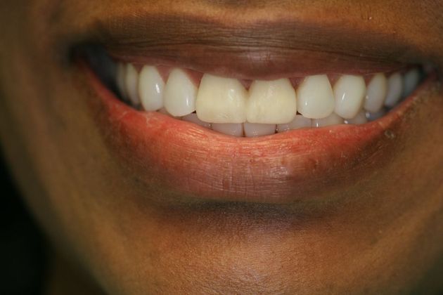 Orthodontics & Veneers Case 5 - Before