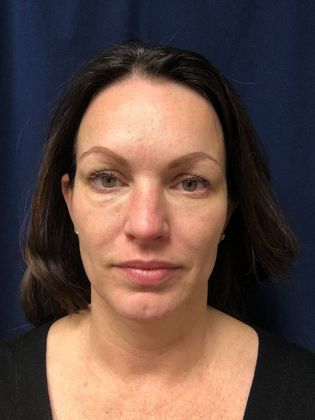 Potenza RF Microneedling : Case 2 - Before