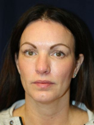 Potenza RF Microneedling : Case 2 - After