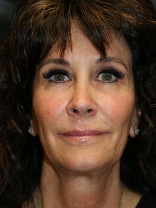 Potenza RF Microneedling : Case 1 - After