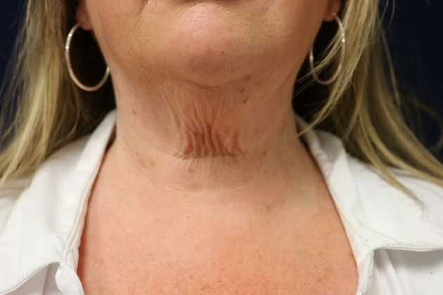 Potenza RF Microneedling : Case 3 - Before