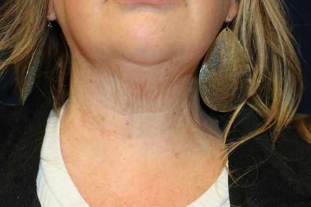 Potenza RF Microneedling : Case 3 - After