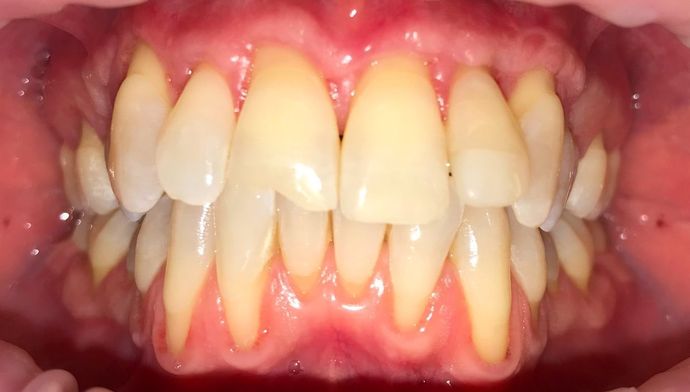 Invisalign Case 2 - Before