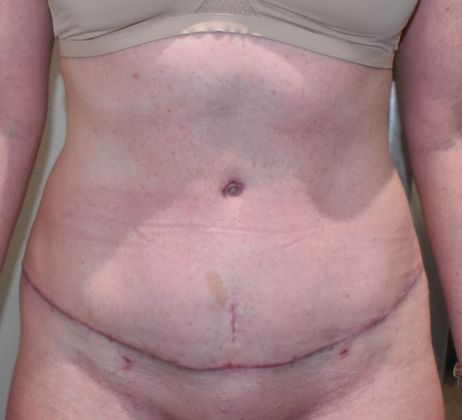 Tummy Tuck (Abdominoplasty): Case 272 - After