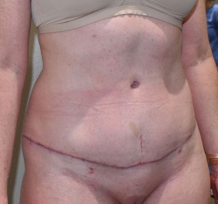 Tummy Tuck (Abdominoplasty): Case 272 - After