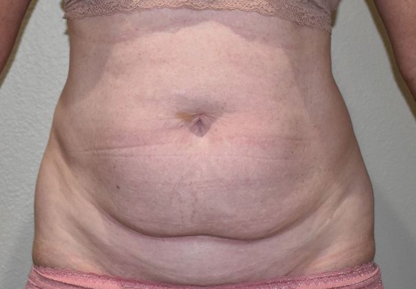 Tummy Tuck (Abdominoplasty): Case 272 - Before