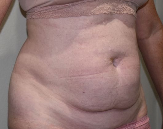 Tummy Tuck (Abdominoplasty): Case 272 - Before
