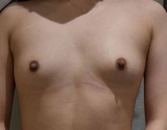 Breast Augmentation Case 623 - Before
