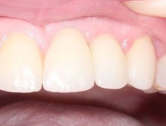 Patient after getting implant restorations