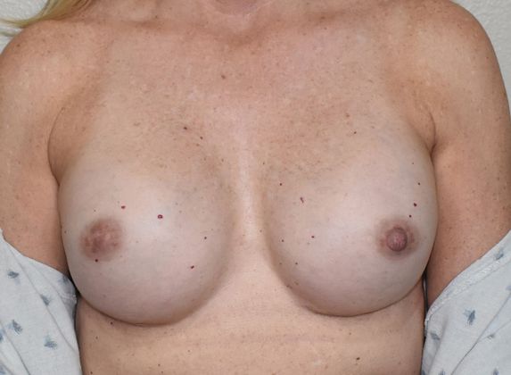Breast Reconstruction Case 60 - After