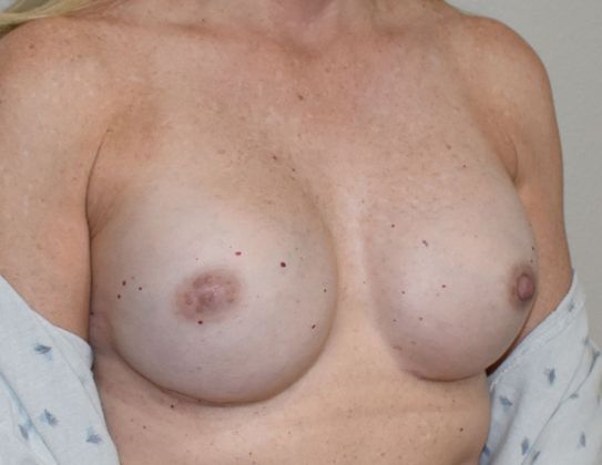 Breast Reconstruction: Case 60 - After