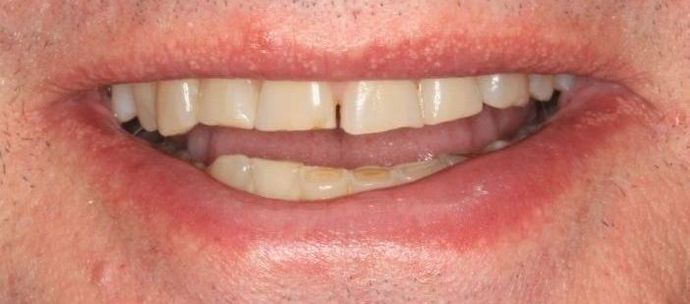 Porcelain Veneers: Case 21 - Before