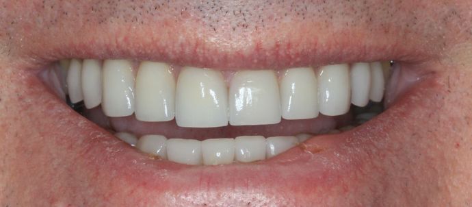 Porcelain Veneers: Case 21 - After