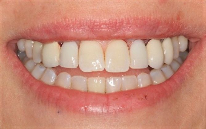 Porcelain Veneers Case 25 - Before