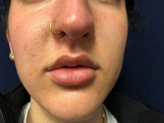 Cosmetic Injectables & Fillers*: Case 39 Lip Filler - Before