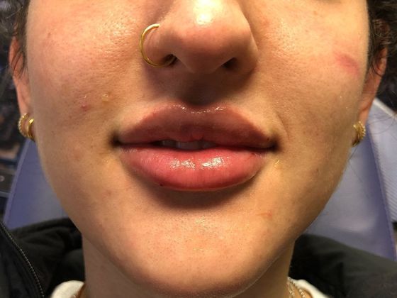 Cosmetic Injectables & Fillers*: Case 39 Lip Filler - After