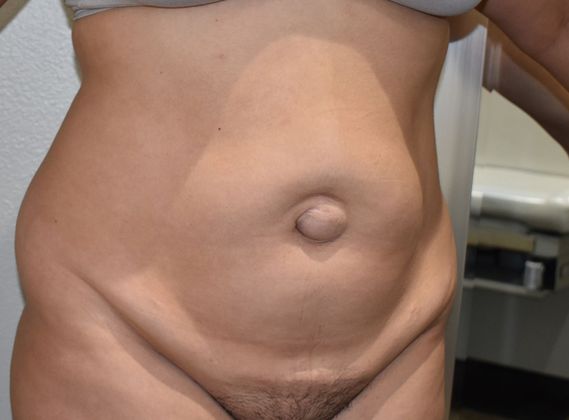 Tummy Tuck (Abdominoplasty): Case 273 - Before