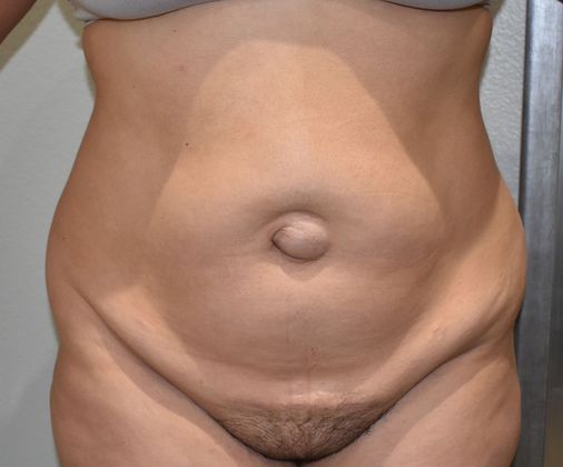 Tummy Tuck (Abdominoplasty): Case 273 - Before