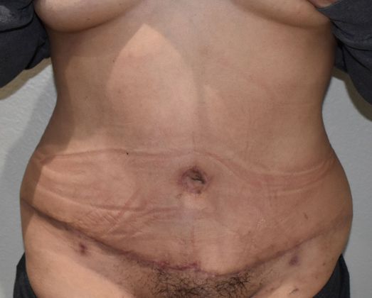 Tummy Tuck (Abdominoplasty): Case 273 - After